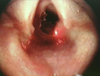 Continued lasering of the subglottic stenosis in a