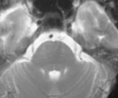 Axial T2-weighted MRI demonstrates no obvious abno