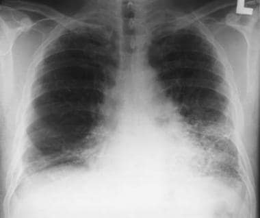 Asbestosis. Posteroanterior chest radiograph in a 