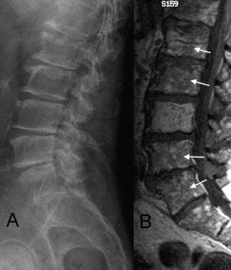 A. Lateral radiograph of the spine in a patient wi