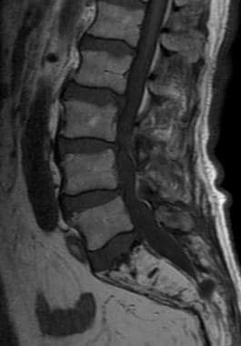 Sagittal T1-weighted MRI of the lumbosacral spine 