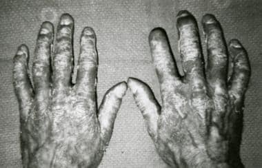 Dorsal view of the hands shows psoriatic rash and