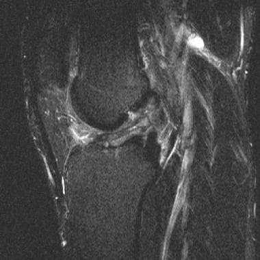 Partial ACL tear. T2 sagittal image shows attenuat