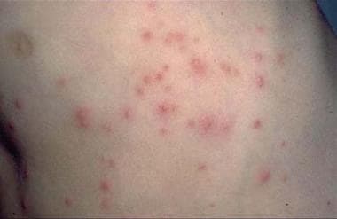 Pseudomonas folliculitis. Courtesy of Hon Pak, MD.