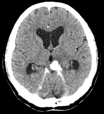 Axial contrast-enhanced CT shows a tuberculoma at 