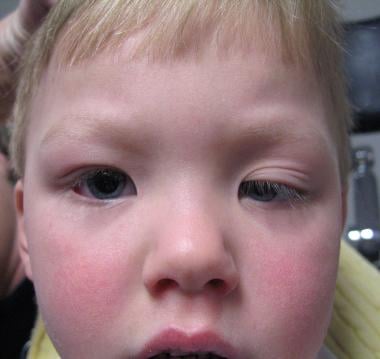 Congenital ptosis of the left eye partially obstru