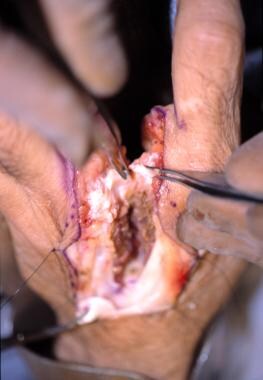 The deep transverse metacarpal ligaments are ident