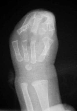 Radiograph of left hand of patient with type III A