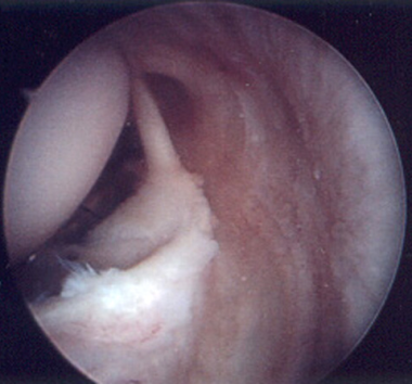 Arthroscopic examination demonstrates significant