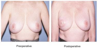Latissimus dorsi breast reconstruction. 