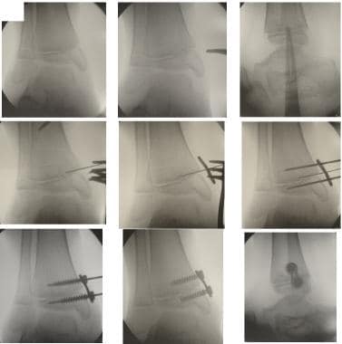 Fluoroscopic sequence showing the steps. The 24-mm