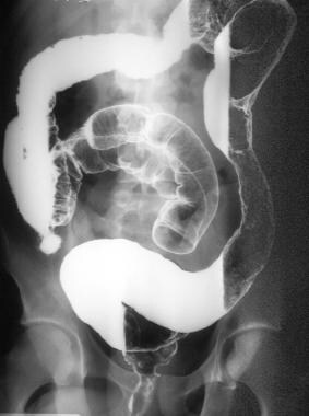 Double-contrast barium enema (same patient as in t