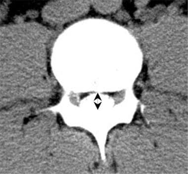 Lumbar computed tomography (CT) myelogram scan dem