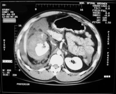 Blunt abdominal trauma. Right kidney injury with b