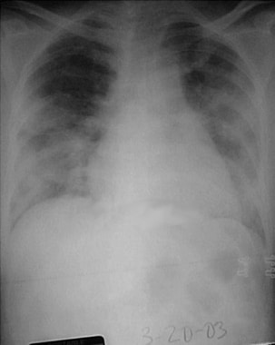 Chest radiograph of a 52-year-old symptomatic woma