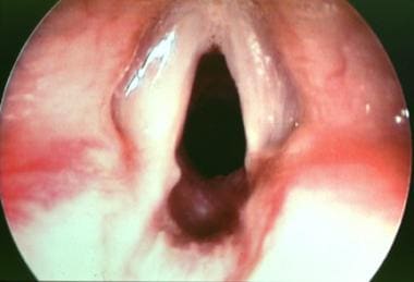 Endoscopic view of the same patient (9-year-old bo