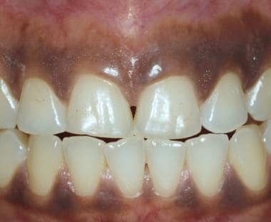 Persons of color frequently have intraoral pigment