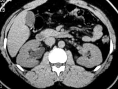Right-sided hydronephrosis secondary to mid ureter