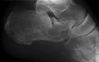Calcaneus, fractures. Plain radiographs and CT sca