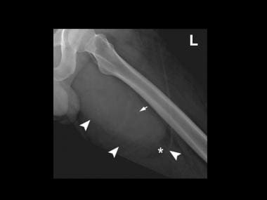 A plain radiograph of a left femur demonstrates a 
