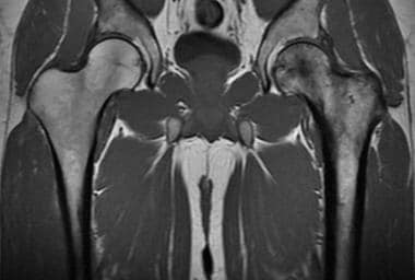 Coronal T1-weighted MRI of the hips shows Paget di