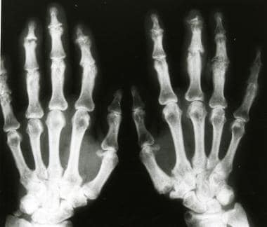 Anteroposterior radiograph of the hands shows subc