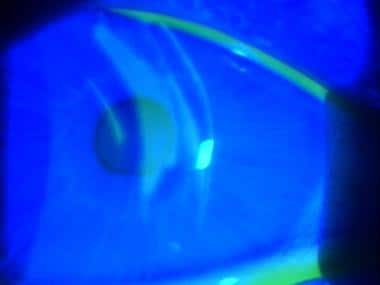 Corneal foreign body with cobalt blue lighting sho