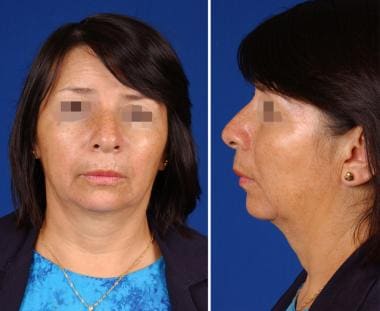 A Patient with aging of the lower face. In additio