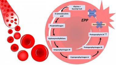In erythropoietic protoporphyria (EPP), there is a