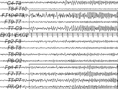 An electroencephalogram (EEG) recording of a tempo