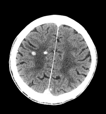 Axial contrast-enhanced CT shows multiple enhancin