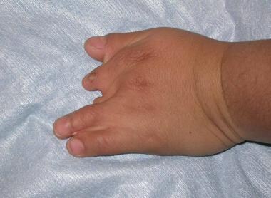 Poland syndrome. Dorsal view of left hand in patie