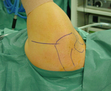 The posterior approach to the shoulder begins at t