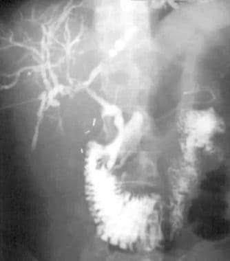 Percutaneous transhepatic cholangiogram shows dila