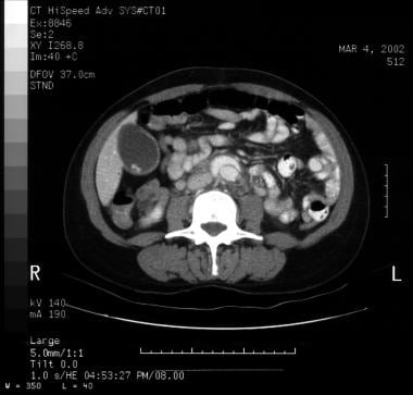 Aortic dissection. CT scan showing a flap. 