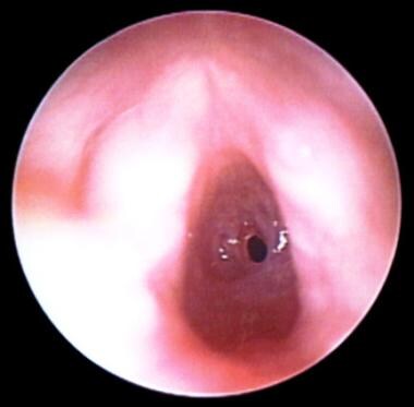 Preoperative view of a 4-month-old infant with acq