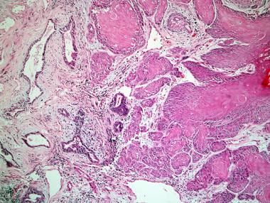 Squamous cell carcinoma of the prostate. 