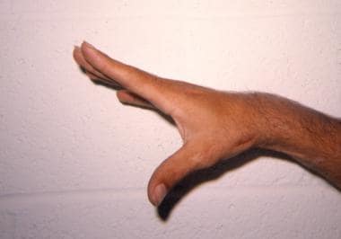 Postoperative photo of the same hand following a C