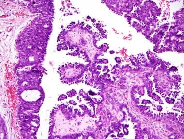 Pathology of small, peripheral intraductal papillo