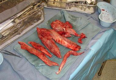 Myonecrosis. Excised muscle from a patient with a