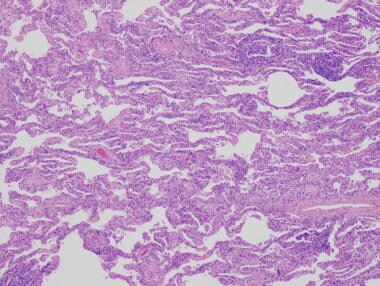 A case of hypersensitivity pneumonitis in a 48-yea