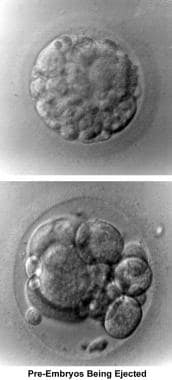 Infertility. Preembryos being ejected. Image court