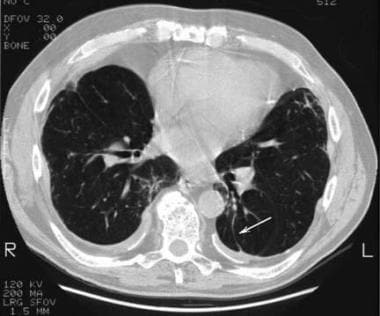 Asbestosis. High-resolution CT scan through the mi