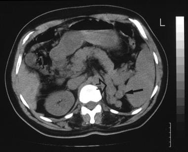 A 52-year-old man with known hepatitis B cirrhosis