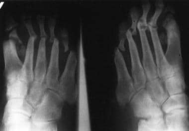 Anteroposterior radiograph of the feet shows arthr