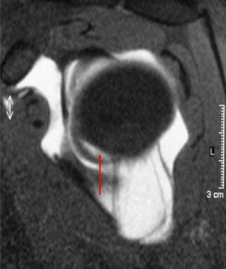 Glenoid Labrum Injury Mri: Overview, Radiography, Computed Tomography