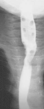 Anteroposterior esophagram (obtained in the same p