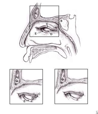 (A) Frontal sinus, (B) sphenoid sinus, (C) cut sur