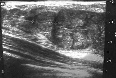 Fibroadenoma. Ultrasonogram courtesy of Helen Pass