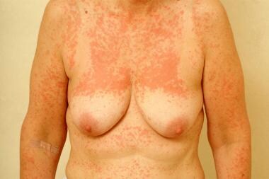 Phototoxic reaction after use of a tanning booth. 